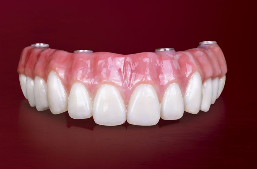   Naujas žingsnis odontologijoje – cirkonio keramikos implantai