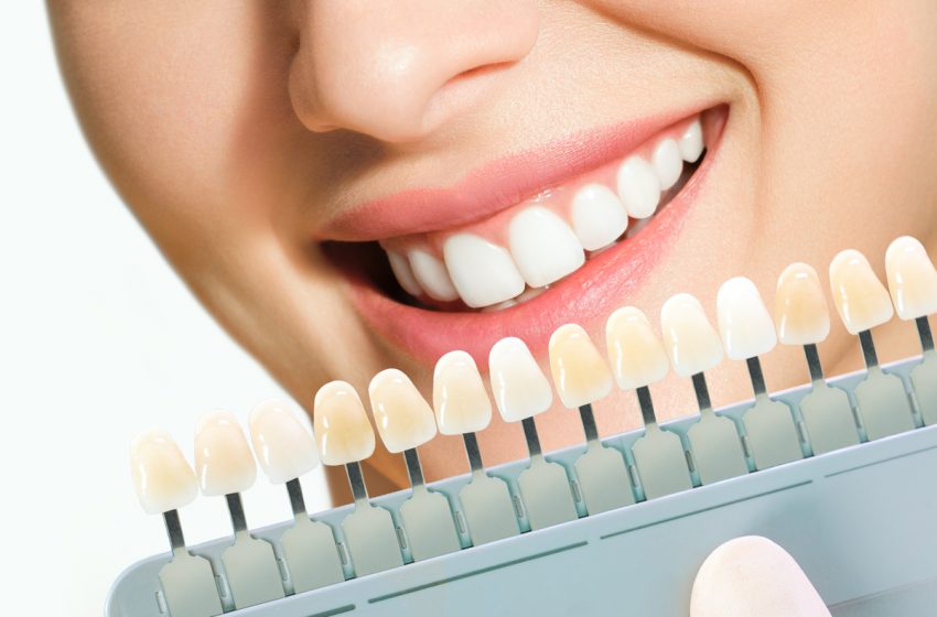  Be komplikacijų pasiekiamas dantų baltumas: kodėl dantis balinti turi odontologas?