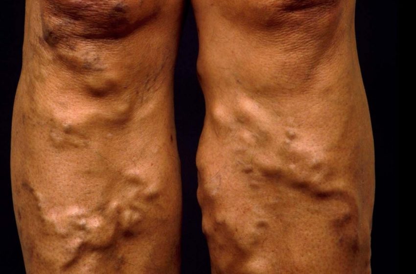  Venų operacijų pokyčiai Lietuvoje: kam gali tekti mokėti nuo liepos?